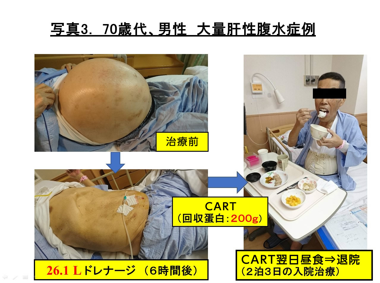 腹水 余命 肝臓 末期がんになって気づいたことがある 「余命１カ月」の男性が遺した言葉：朝日新聞GLOBE＋