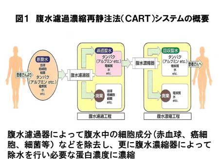 図１　腹水濾過濃縮再静注法（ＣＡＲＴ）システムの概要