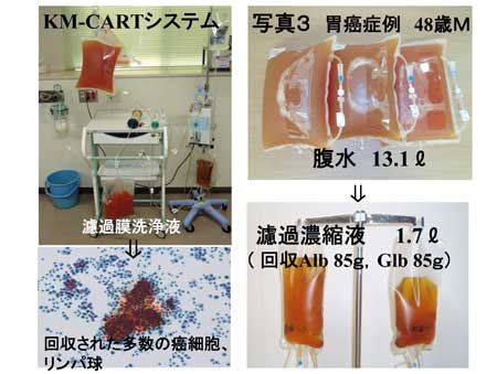 写真3 胃癌症例 48歳M