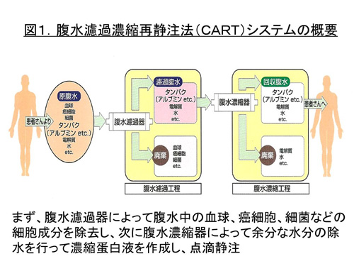 図１　腹水濾過濃縮再静注法（ＣＡＲＴ）システムの概要