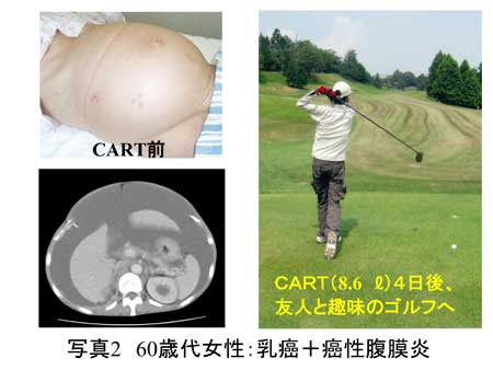 写真2 76歳女性：乳癌＋癌性腹膜炎